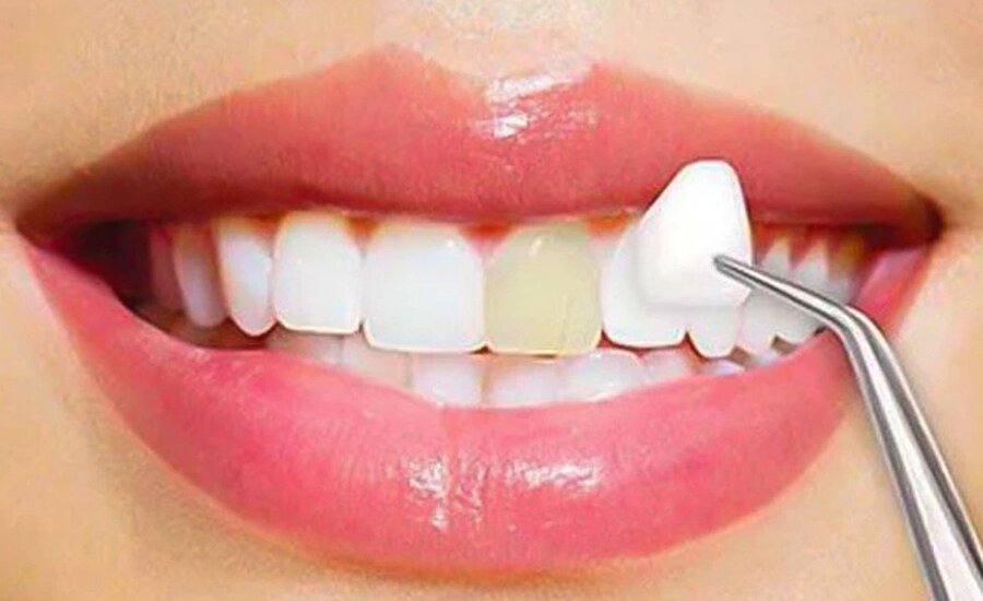 procelain veeners cosmetic dentistry procedures