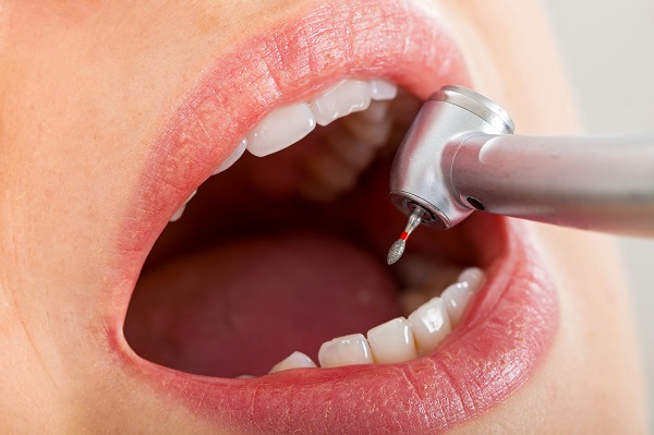 close,up,picture,of,dental,drill,in,young,female,patient's