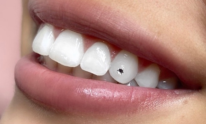 tooth gems cosmetic dentistry teeth gems best dentist in tijuana tooth piercing tijuana mexico teeth gems
